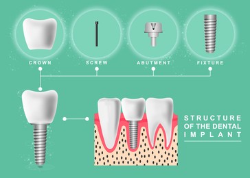 Image of Structure of dental implant on light green background, illustration. Educational poster