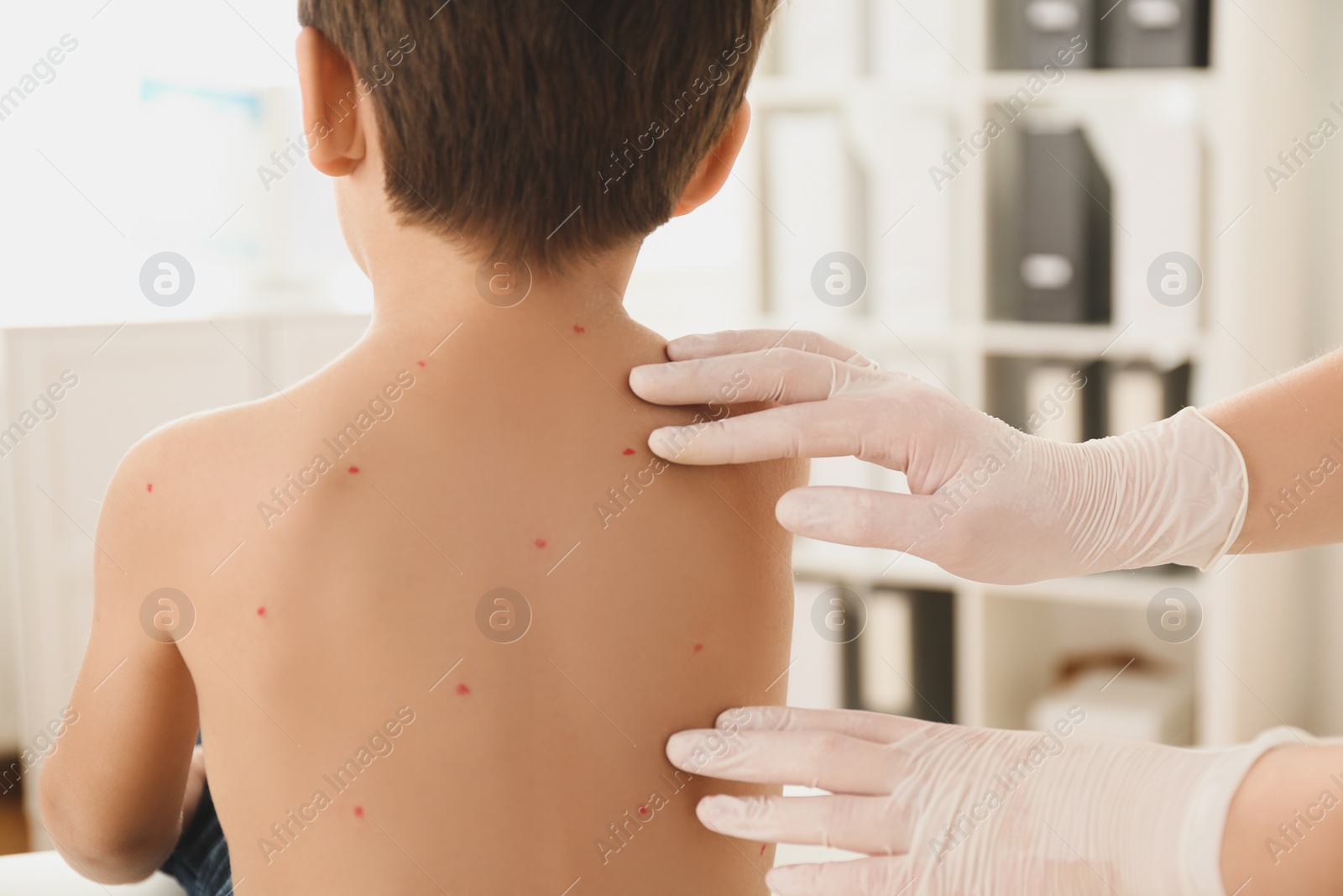 Photo of Doctor examining little boy with chickenpox in clinic, closeup. Varicella zoster virus