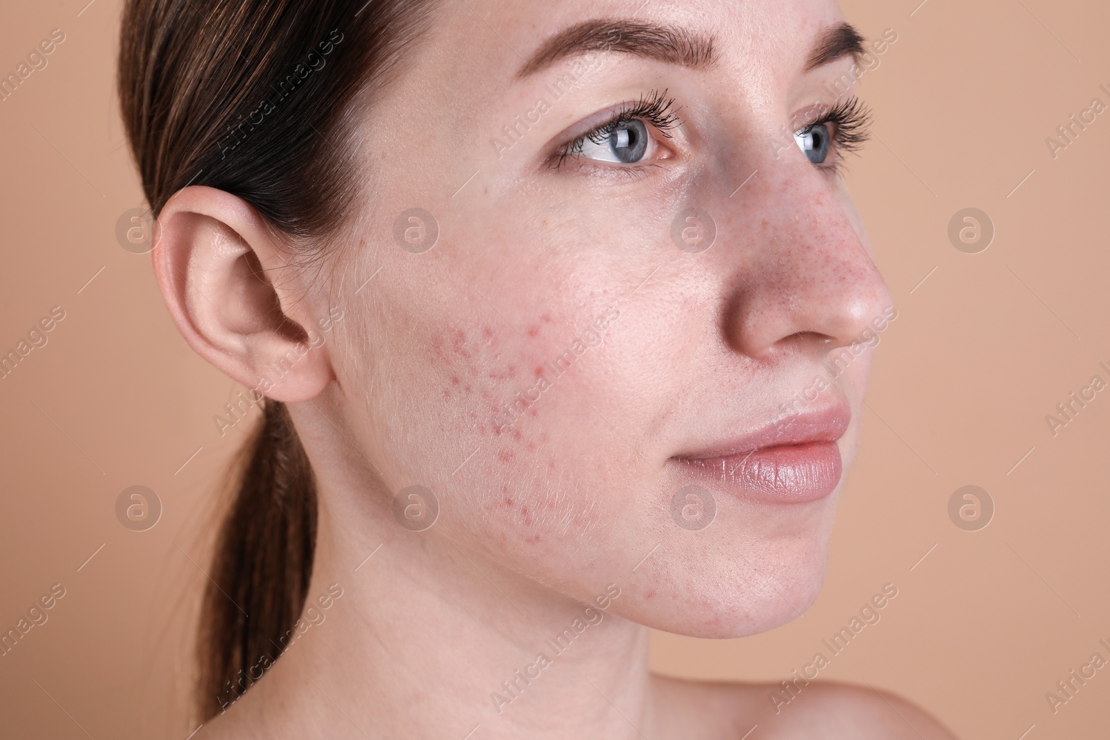 Photo of Young woman with acne problem on beige background, closeup