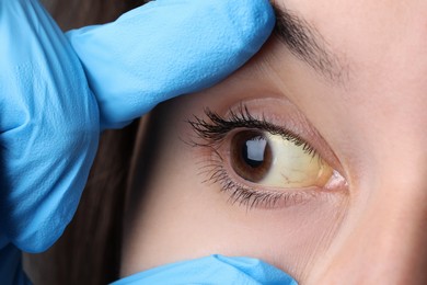Photo of Doctor checking woman with yellow eyes, closeup. Symptom of hepatitis