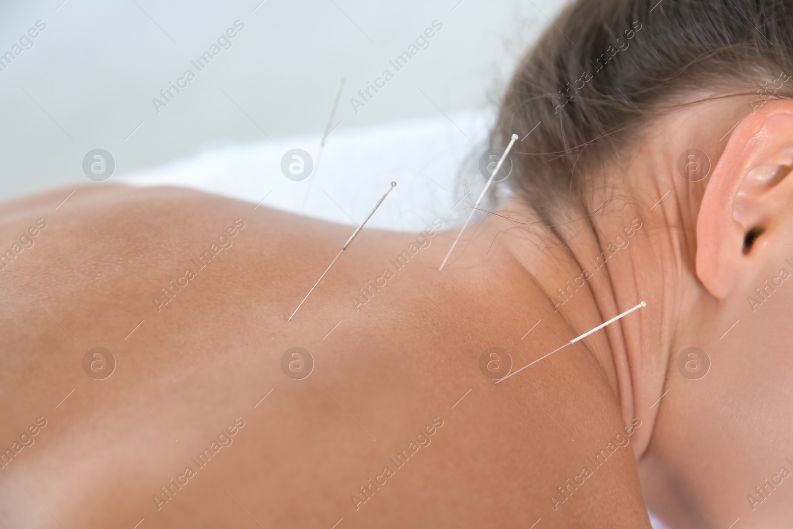 Photo of Young woman undergoing acupuncture treatment in salon, closeup