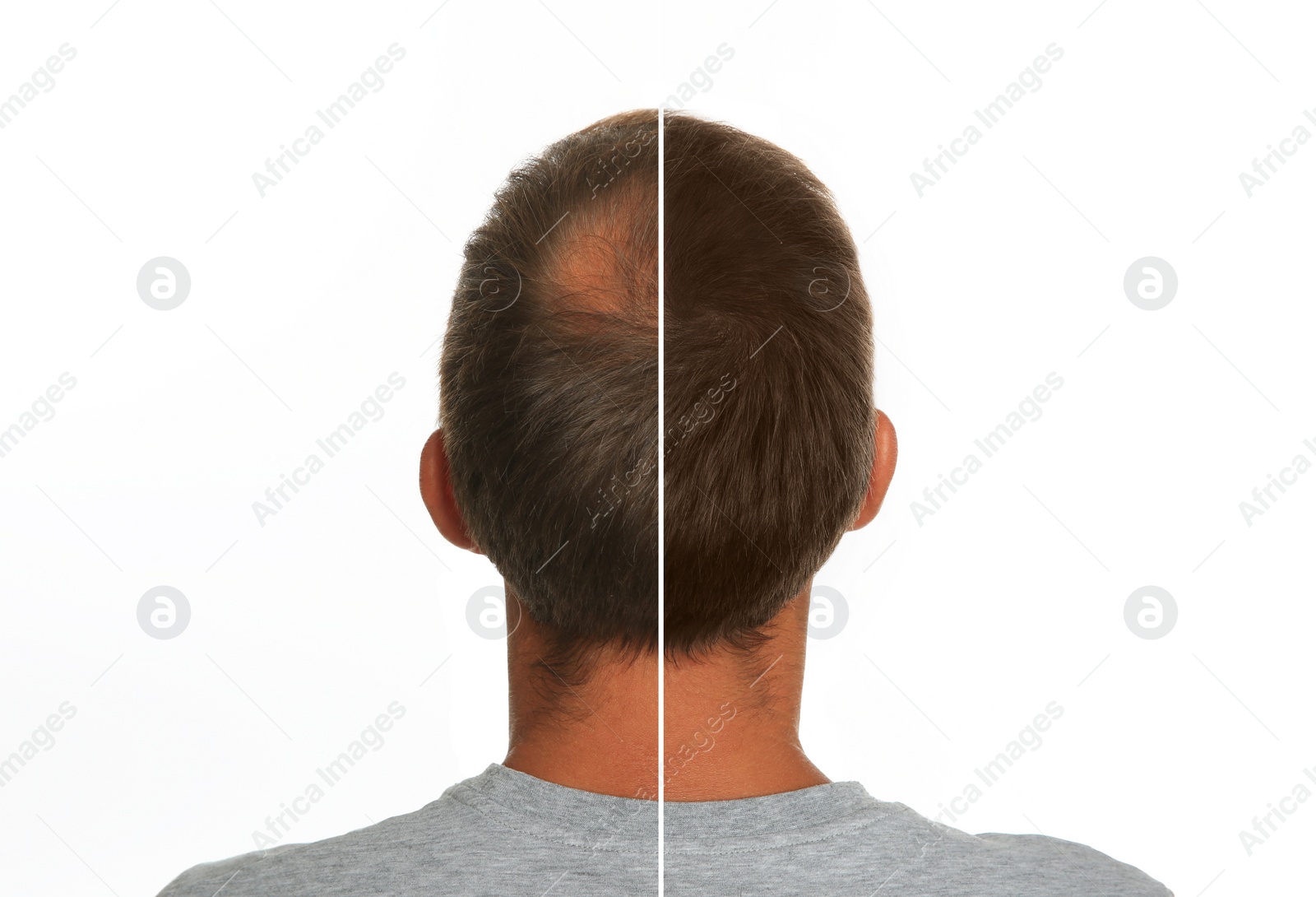 Image of Man with hair loss problem before and after treatment on white background, collage. Visiting trichologist