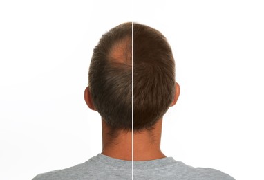 Man with hair loss problem before and after treatment on white background, collage. Visiting trichologist