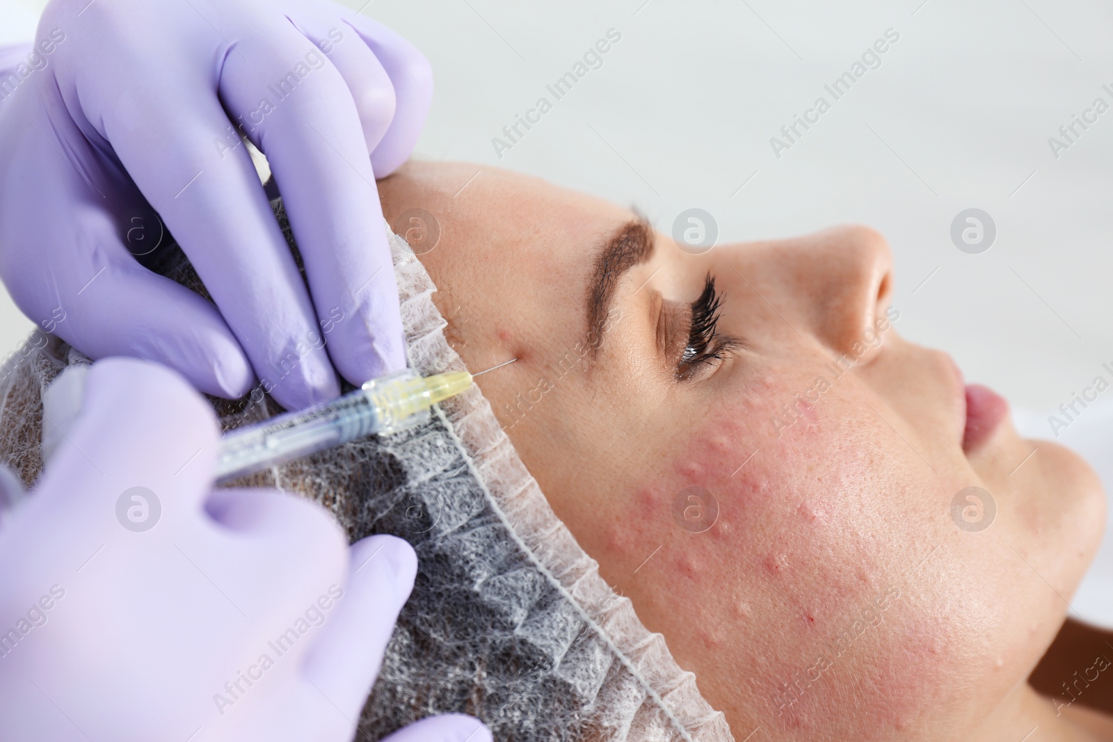 Photo of Woman undergoing face biorevitalization procedure in salon, closeup. Cosmetic treatment