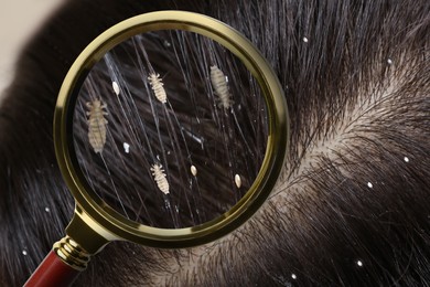 Image of Pediculosis. Woman with lice and nits, closeup. View through magnifying glass on hair