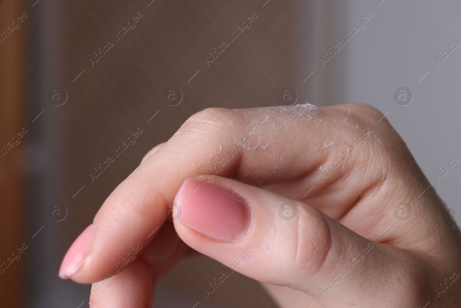 Photo of Woman with dry skin on hand against blurred background, macro view