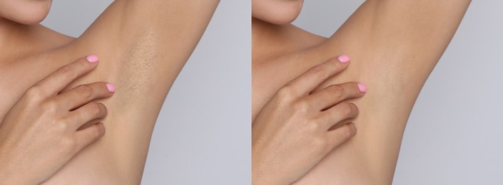 Image of Before and after epilation. Collage with photos of woman showing armpit on light background, closeup