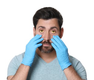 Photo of Man checking his health condition on white background. Yellow eyes as symptom of hepatitis