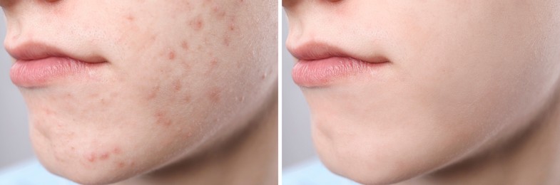 Acne problem. Young man before and after treatment on grey background, closeup. Collage of photos