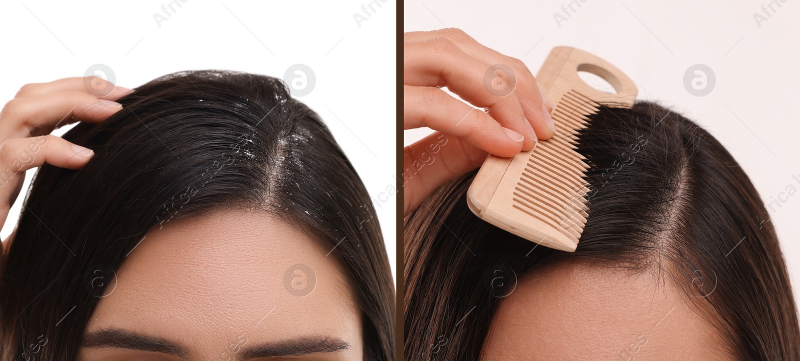 Image of Woman showing hair before and after dandruff treatment on white background, collage