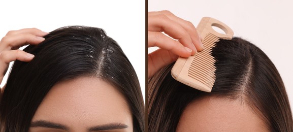 Woman showing hair before and after dandruff treatment on white background, collage