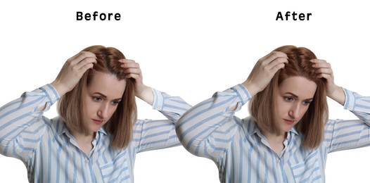 Image of Woman suffering from baldness on white background, banner design. Collage with photos before and after treatment