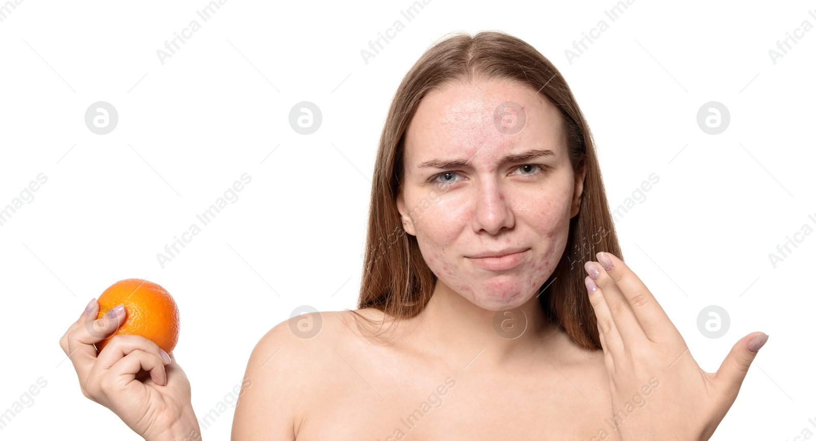 Photo of Young woman with acne problem holding orange on white background. Skin allergy