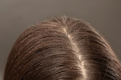 Photo of Woman with dandruff in her dark hair on grey background, closeup