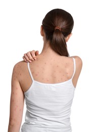 Photo of Woman with rash suffering from monkeypox virus on white background, back view