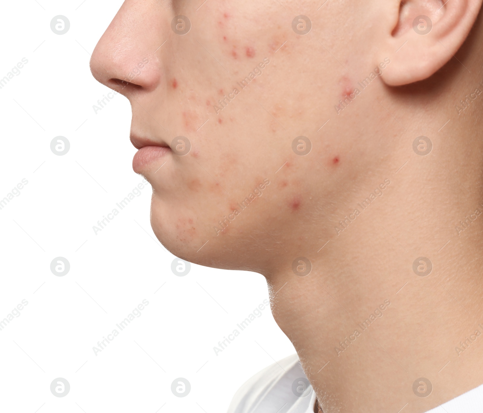 Photo of Teen guy with acne problem on white background, closeup