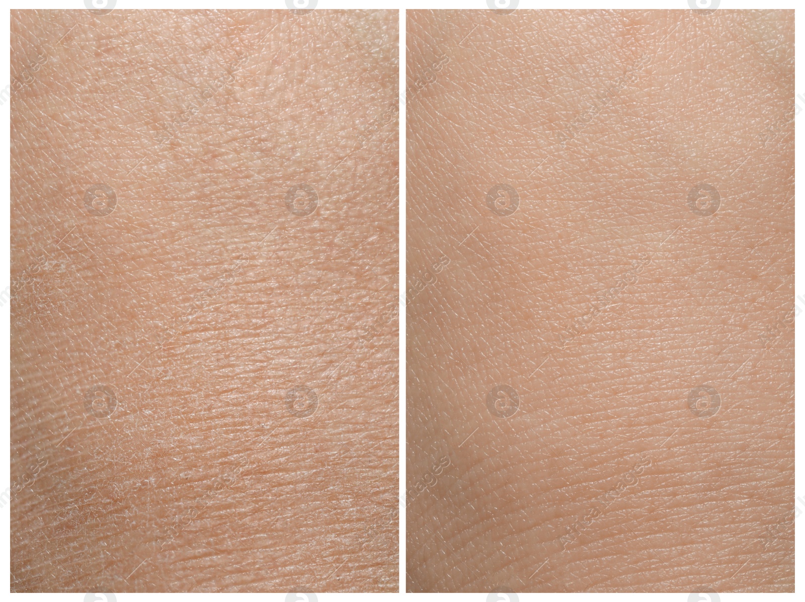 Image of Collage demonstrating comparison of dry and moisturized human skin, closeup