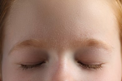 Photo of Little boy with dry skin on face, closeup