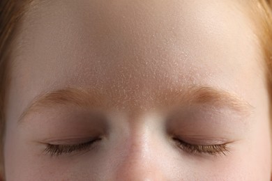 Little boy with dry skin on face, closeup