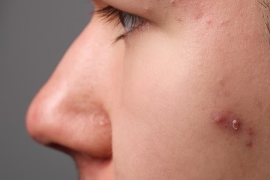 Photo of Young man with acne problem on grey background, closeup view