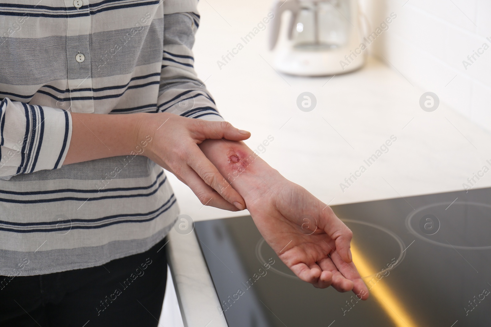 Photo of Woman with burn on her forearm in kitchen, closeup