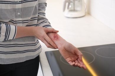 Photo of Woman with burn on her forearm in kitchen, closeup