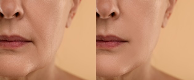 Image of Aging skin changes. Woman showing face before and after rejuvenation, closeup. Collage comparing skin condition