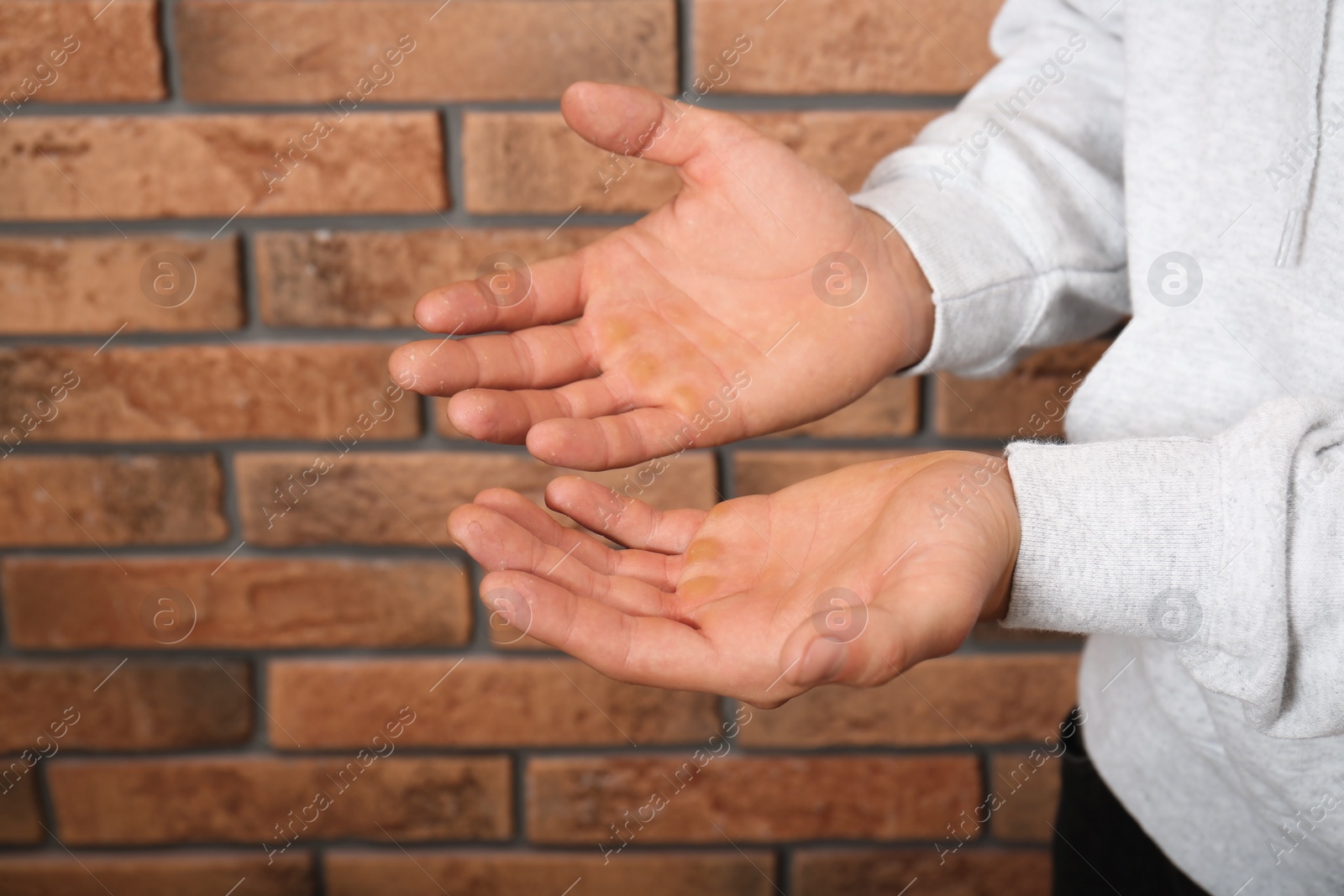 Photo of Man suffering from calluses on hands near brick wall, closeup