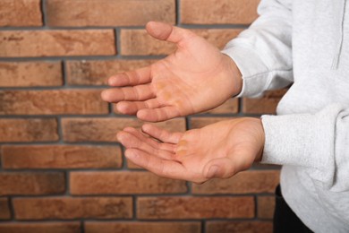 Man suffering from calluses on hands near brick wall, closeup