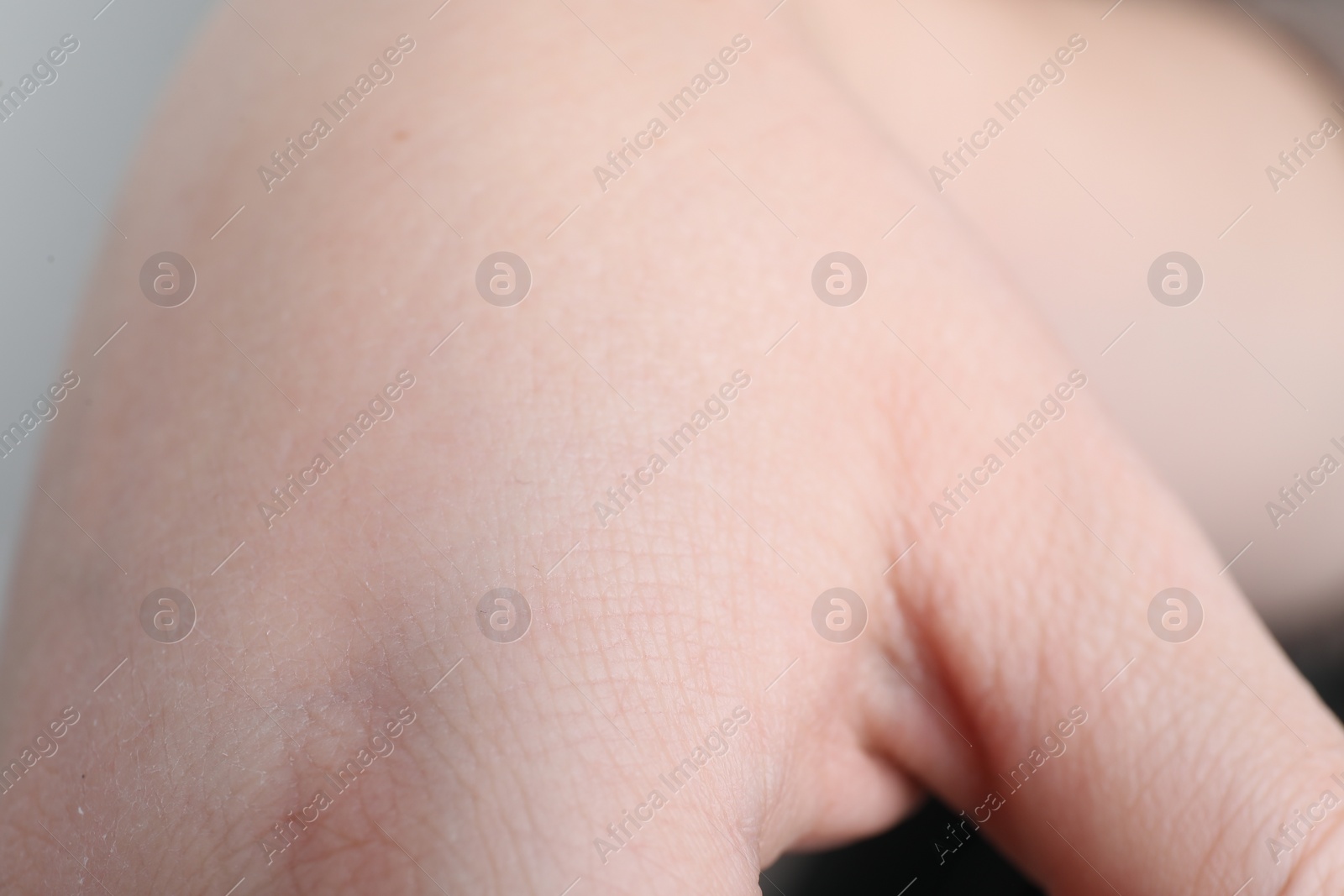 Photo of Woman with dry skin on hand, closeup