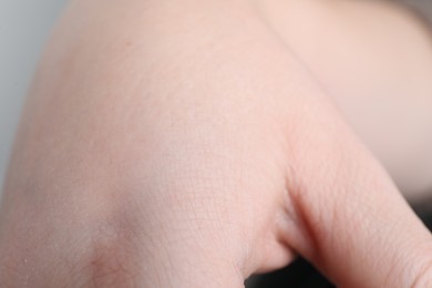 Photo of Woman with dry skin on hand, closeup