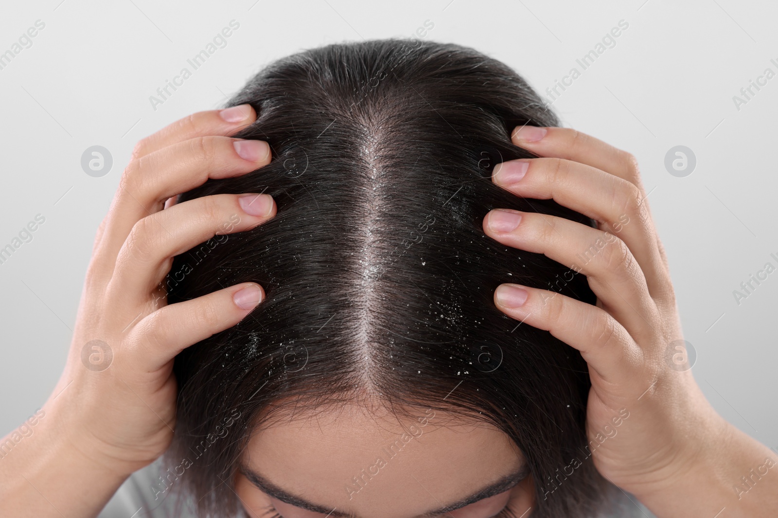 Photo of Woman with dandruff problem on white background, closeup