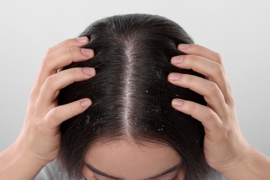 Woman with dandruff problem on white background, closeup
