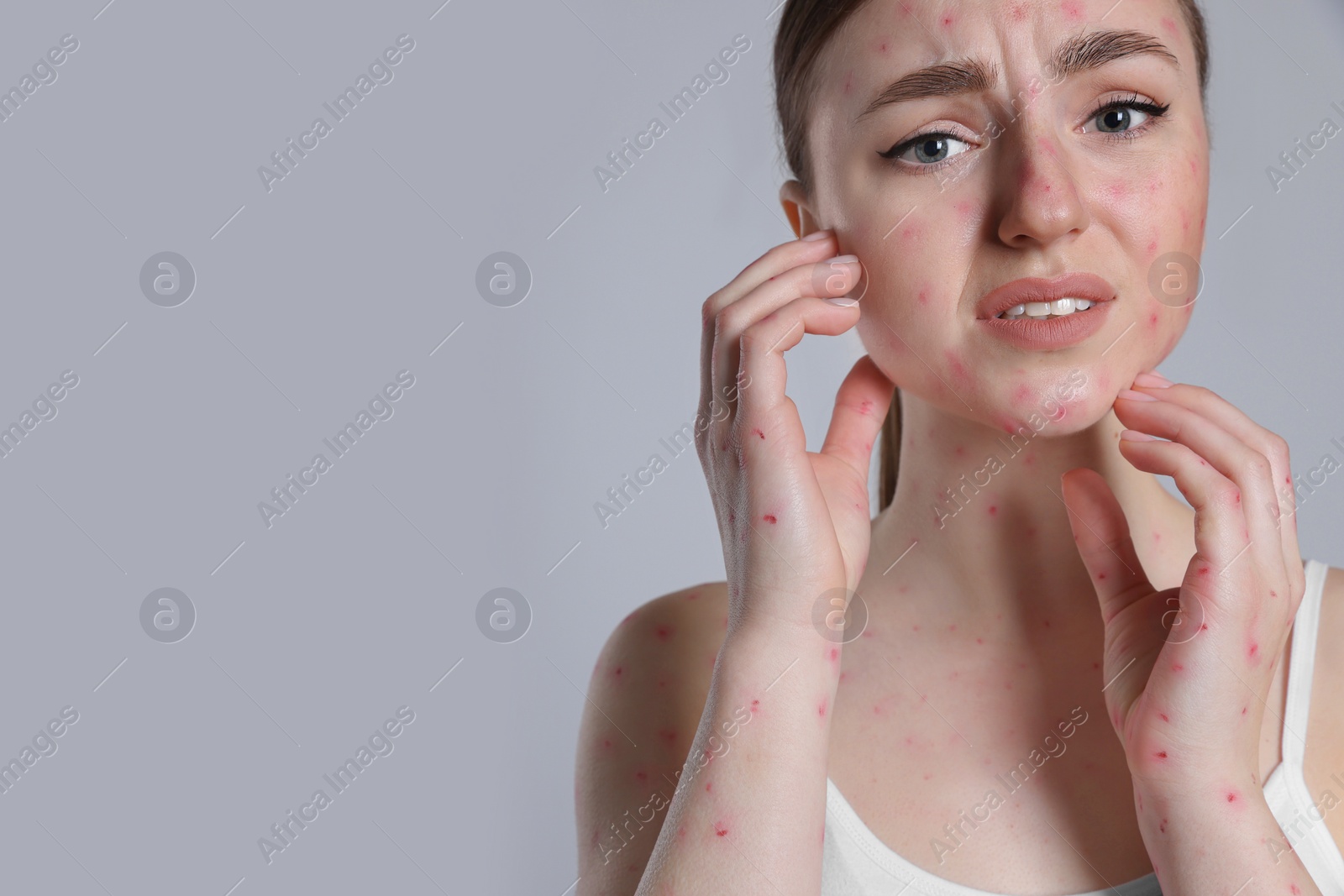 Photo of Woman with rash suffering from monkeypox virus on light grey background. Space for text