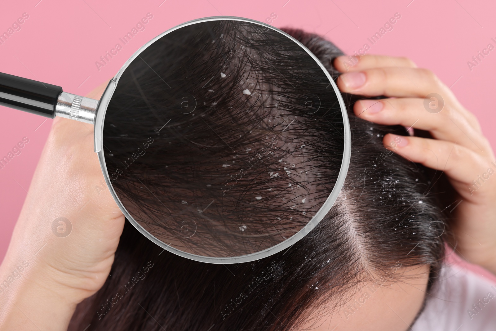 Image of Woman suffering from dandruff on pink background, closeup. View through magnifying glass on hair with flakes