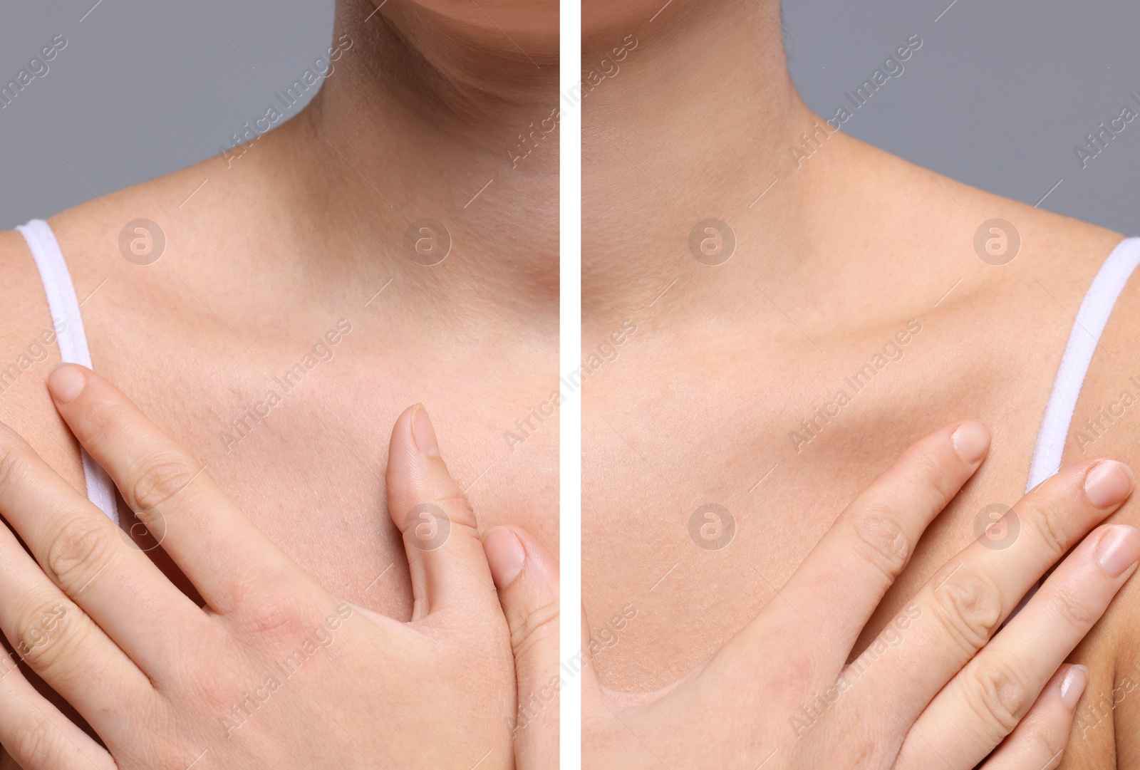 Image of Aging skin changes. Woman showing neck before and after rejuvenation, closeup. Collage comparing skin condition