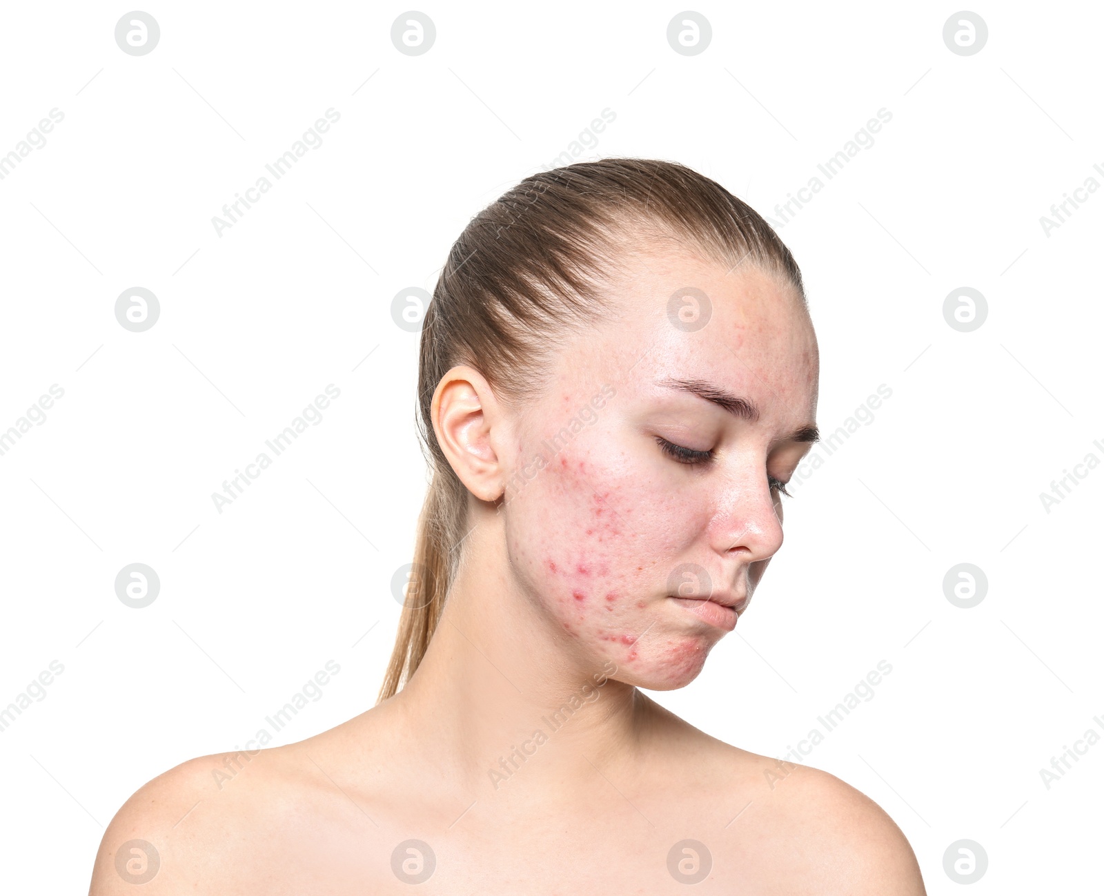 Photo of Young woman with acne problem on white background