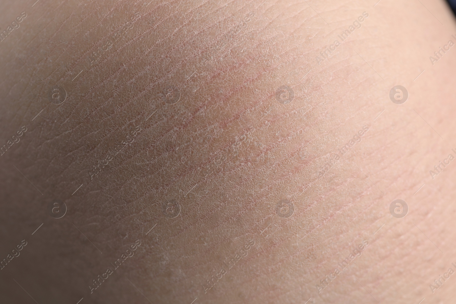 Photo of Closeup view of woman with dry skin