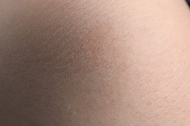 Photo of Closeup view of woman with dry skin