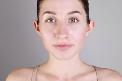 Young woman with acne problem on light grey background