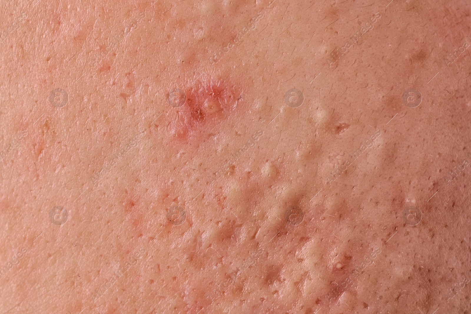 Photo of Young person with acne problem, closeup view of skin