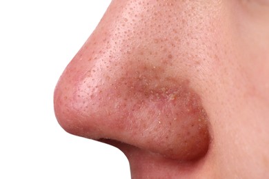 Young man with acne problem on grey background, closeup view of nose