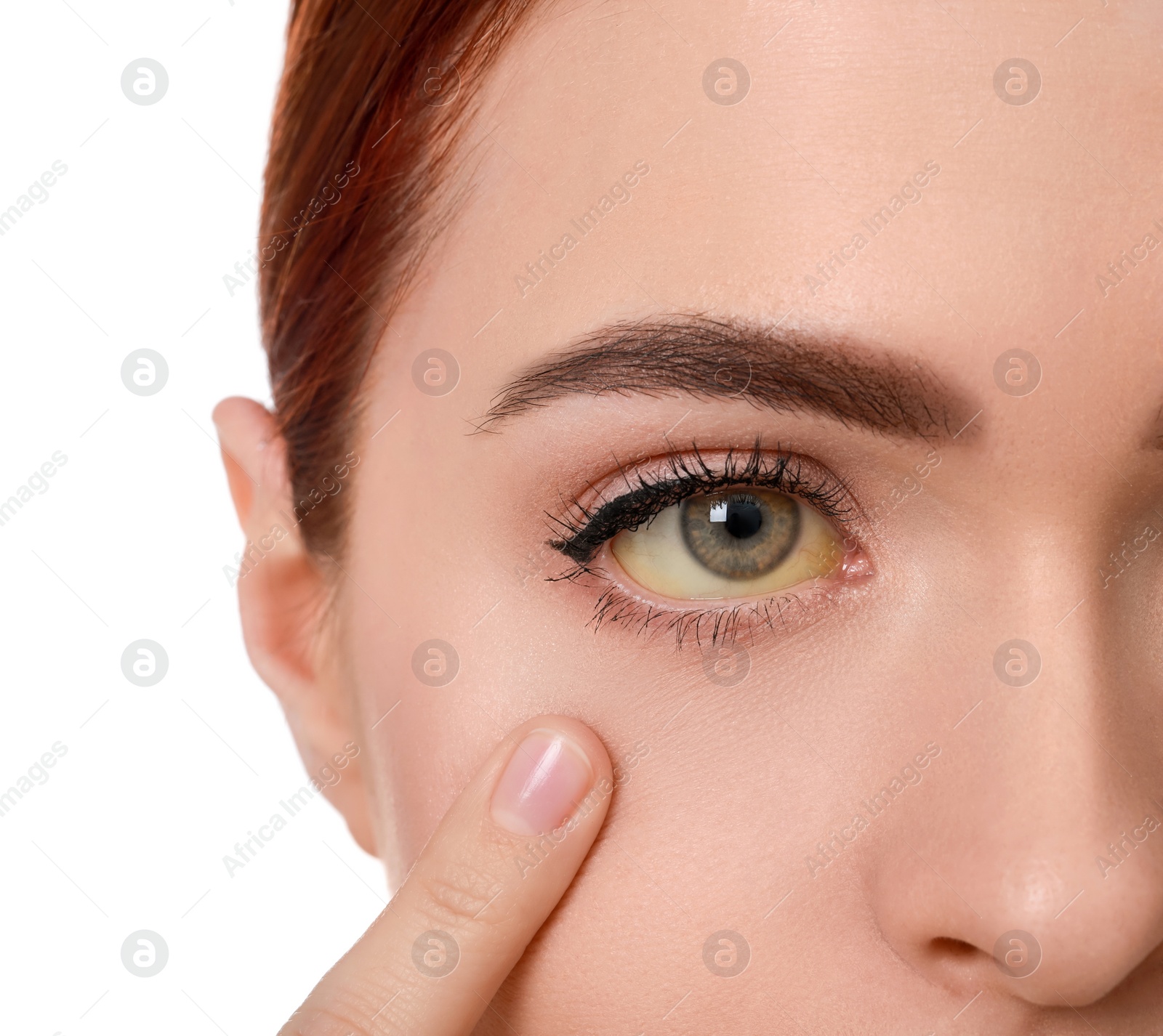 Photo of Woman with yellow eyes on white background, closeup. Symptom of hepatitis