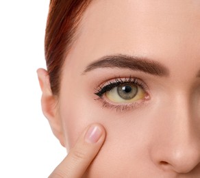 Photo of Woman with yellow eyes on white background, closeup. Symptom of hepatitis