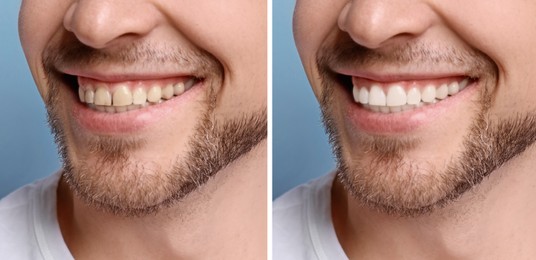 Image of Collage with photos of man before and after teeth whitening, closeup. Banner design