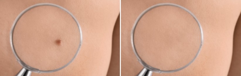 Image of Collage with photos of patient's back before and after mole removing procedure, closeup. Looking at skin through magnifying glass