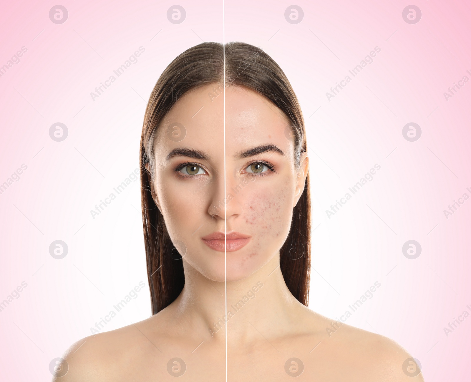 Image of Young woman with acne problem before and after treatment on light background, collage