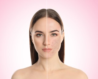 Image of Young woman with acne problem before and after treatment on light background, collage