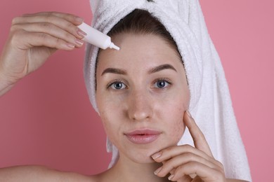 Young woman with acne problem applying cosmetic product onto her skin on pink background