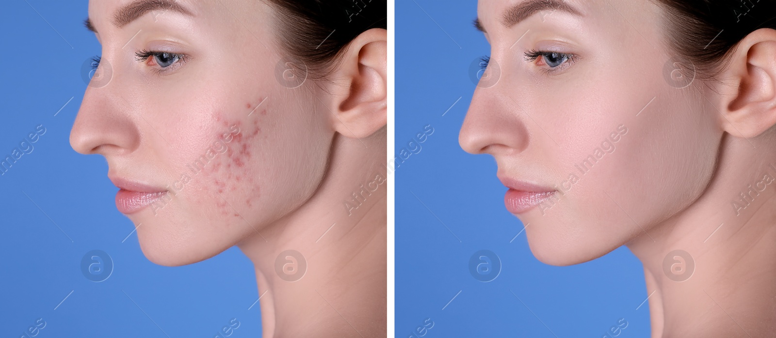 Image of Acne problem. Young woman before and after treatment on blue background, collage of photos